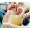 Application of FlexiCol Hydrocolloid Wound Dressing