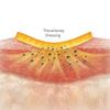 Foam Flex Dressing- Osmotic Action of Manuka Honey