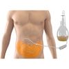 Using PleurX Drainage Kit for Abdomen