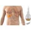 PleurX Catheter in Chest