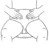 Nu-Hope Non-Adhesive Left Side Stoma Ileostomy Starter Set